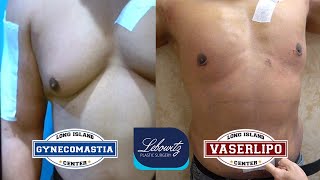 Gynecomastia Surgery 3 DAYS POSTOP RESULTS ‼️🔥💪🏼🏋️ [upl. by Seumas]