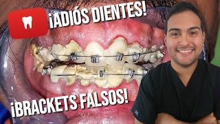 BRACKETS FALSOS 😱 ¡EL PELIGRO DE LA ORTODONCIA CALLEJERA CASOS REALES 41 [upl. by Gnoy]