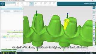 21 Implant Bridge  WorkNC Dental Training Video [upl. by Notsnarc]