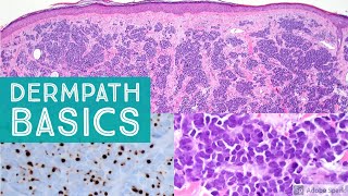 Basic Dermpath Cases  Explained by a Dermatopathologist [upl. by Etteloc528]