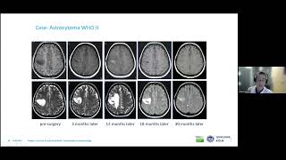 Minimally invasive techniques in brain oncology  D Ruess [upl. by Spring24]