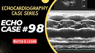 ECHO CASE 98  Echocardiography for Beginners  M Mode Echocardiogram [upl. by Aryc]