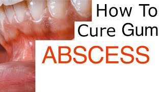 Gum Abscess Explained [upl. by Asila462]