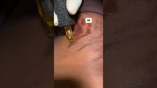 Stretch mark removal in South Africa Stretch mark removal at home [upl. by Naicad]