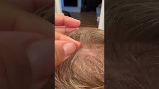 Lice picking l lice removal l small business explore hair lice hairvideo [upl. by Oel]