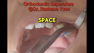 Orthodontic Seperators  spacers [upl. by Bo]