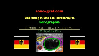 Sonographie  Einblutung In Eine Schilddrüsenzyste [upl. by Sible]