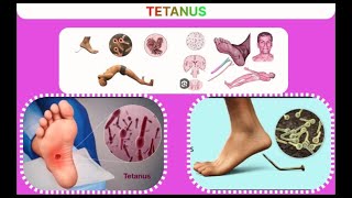 Tetanus  تشنج  धनुस्तंभ [upl. by Otrevire]