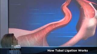 Vasectomy or Tubal Ligation Medical Course [upl. by Nerra]