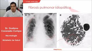 Enfermedades Pulmonares Intersticiales [upl. by Anaehr]