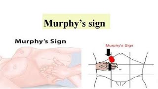 Murphys Sign in Acute Cholecystitis  Meaning of Positive or Negative and Procedure to elicit [upl. by Red]