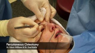 Percutaneous Osteotomy amp Breaking the Nose During Rhinoplasty Surgery [upl. by Tenneb]