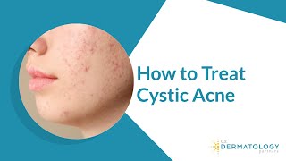 How to Treat Cystic Acne [upl. by Ecertal]