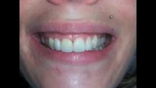 Sourire gingival et facettes dentaires [upl. by Ariana]