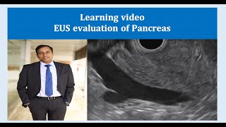 EUS pancreas evaluation  Dr Vikas Singla [upl. by Oznole673]