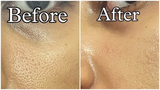 Honestly How I got rid of open pores amp clogged pores  “Unsponsored” [upl. by Yralih]