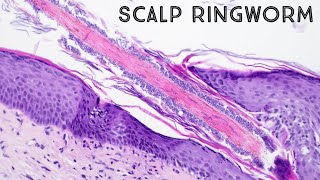 Ringworm under microscope hair follicle fungus in scalp aka tinea capitis pathology dermpath [upl. by Pratt]