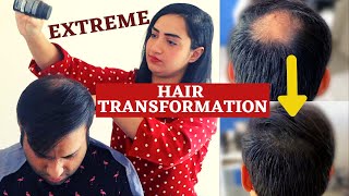 My EXTREME HAIR TRANSFORMATION  TOPPIK Hair FIBRE  Extreme TestHair Illusion for Men [upl. by Dhaf]