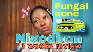 AffordableCheap way to get rid of fungal acneNixoderm for fungal acne forehead rashpimples [upl. by Zoha]