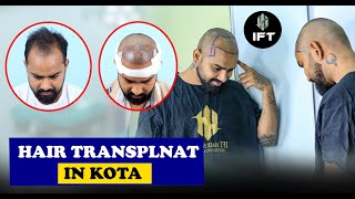 Hair Transplant in Kota Affordable Costs amp Outstanding Results  IFT Hair Science [upl. by Roman]