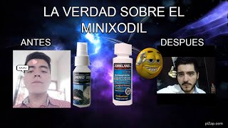 LA VERDAD SOBRE EL MINOXIDIL [upl. by Sivle344]