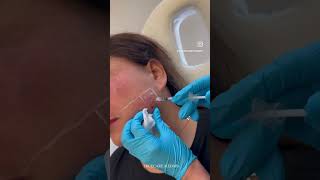 Jawline Slimming with Botox Masseter Reduction [upl. by Terina649]