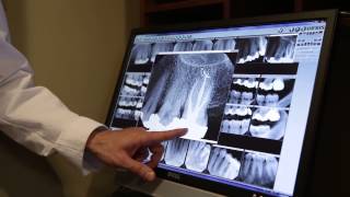 Philadelphia Dentistry  Scaling and Root Planing  Crisp Video [upl. by Kcirrej56]