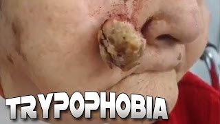 Cysts Blackheads Skin amp Trypophobia [upl. by Reeher]