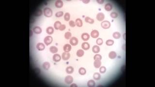 Under the Microscope  Sickle Cell Anemia [upl. by Maritsa]