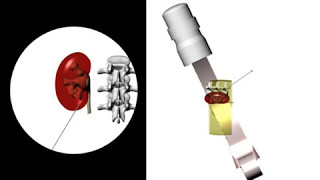 ESUT educational video on fluoroscopic guided puncture in PCNL All techniques step by step [upl. by Iaoh]