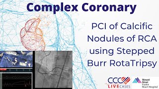 Watch Live PCI of Calcific Nodules of RCA using Stepped Burr RotaTripsy [upl. by Darwen778]