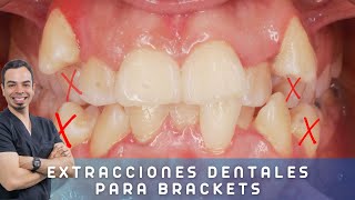 😱 𝐄𝐗𝐓𝐑𝐀𝐂𝐂𝐈𝐎𝐍 𝐝𝐞 𝐏𝐑𝐄𝐌𝐎𝐋𝐀𝐑𝐄𝐒 superiores e inferiores en ORTODONCIAQuitar DIENTES para poner BRACKETS [upl. by Romain]