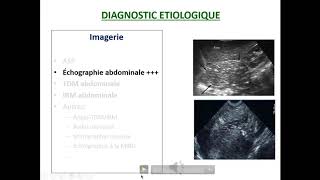 Tumeurs abdominales de lenfant  Comité Pédagogique de pédiatrie  Docteur NALIM [upl. by Narak]