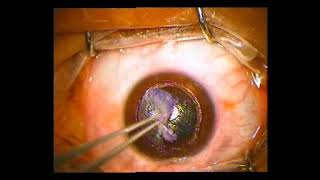 Superior Anterior Lamellar Keratoplasty [upl. by Eulalee388]