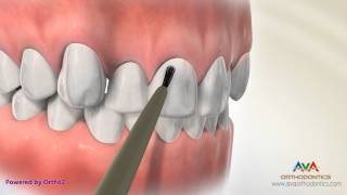 Putting Orthodontic Braces On or Bonding  Indirect vs Direct Technique [upl. by Stegman640]