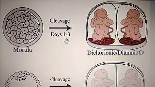 Chorionicity and amniocity [upl. by Page]