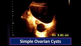 Understanding Simple Ovarian Cysts Ultrasound Findings  Ovarian Cyst  Simple follicular cyst [upl. by Garibald]