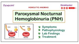 Paroxysmal Nocturnal Hemoglobinuria  PNH  SymptomsPathogenesisLab FindingsTreatment pathology [upl. by Ahaelam969]