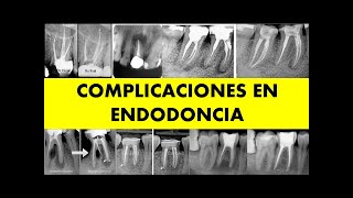 quotCOMPLICACIONES EN ENDODONCIAquot [upl. by Lebatsirc]