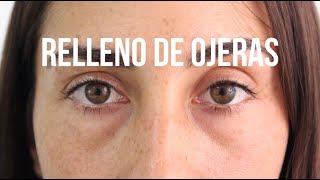 Rellenos de ojeras y pómulos con ácido hialurónico [upl. by Cohby]