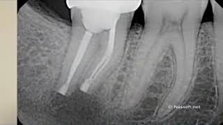 Reimplante Intencional  ENDODONCIA AVANZADA [upl. by Lipinski]