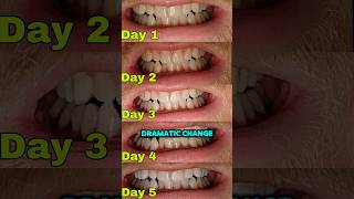 MySmile Teeth Whitening Results [upl. by Barde391]