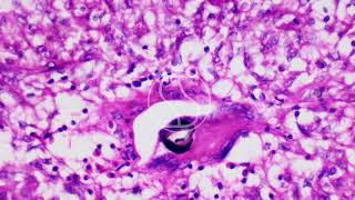 Basidiobolus from Gastrointestinal with GMSHaematoxylin and Eosin Staining [upl. by Atinus]