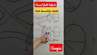 Visual field defect anopiashorts physiology eyes [upl. by Sitto]