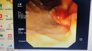 Precut sphincterotomy made easy Malignant EHBO ERCP [upl. by Beora783]