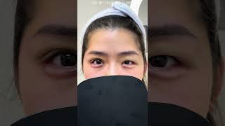 ✨ Double Eyelid Transformation ✨ [upl. by Konrad74]