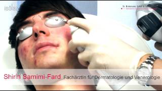 AKNE LIVEBEHANDLUNG  Isolaz und Fraxel Laser  DERMA LOFT Gladbeck [upl. by Blossom]