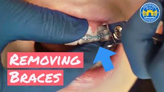 Process of Removing Braces [upl. by Niajneb]