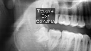 Buccal Trough and Sectioning of Mesioangular Third Molar drwahan [upl. by Graff454]