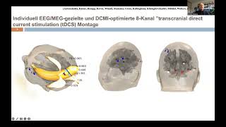 Bioelektromagnetismus Anwendung in d prächirurgischen EpilepsieDiagnose C Wolters Uni Münster [upl. by Nyleek]